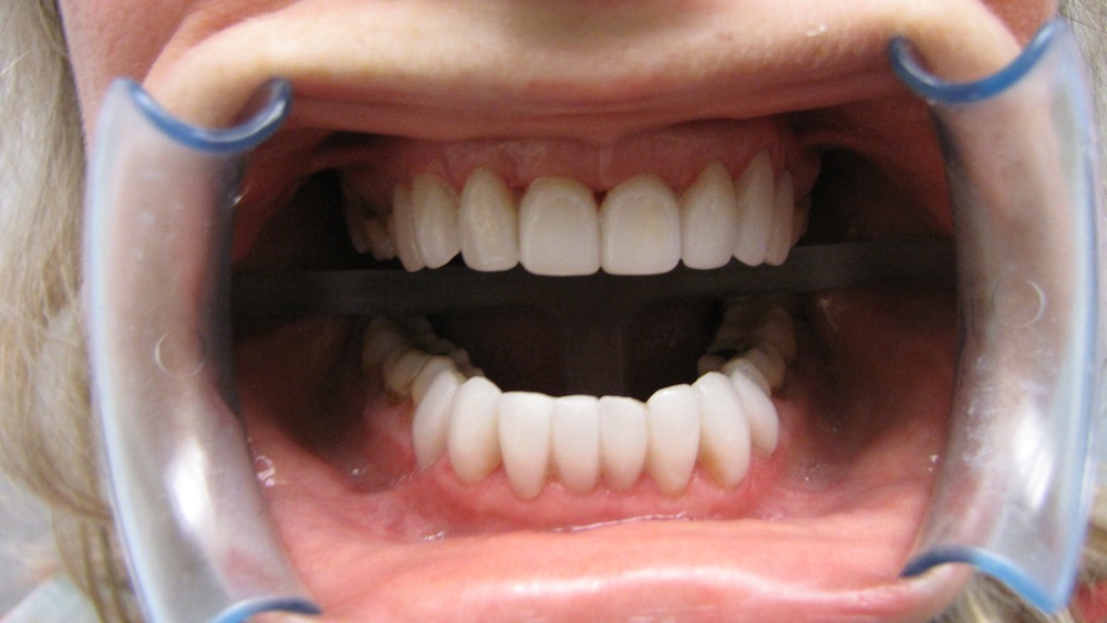 Aprés la pose d'implant et de facette dentaires
