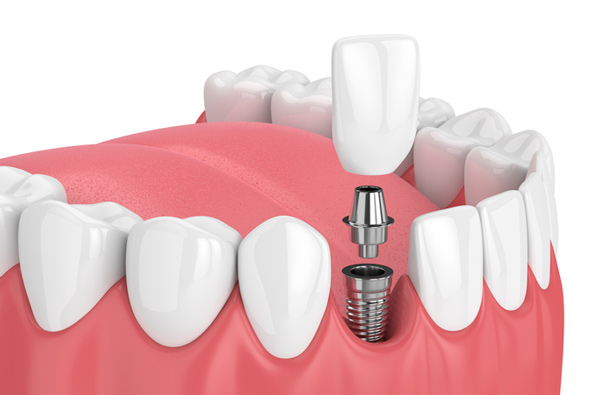 implant dentaire Hongrie