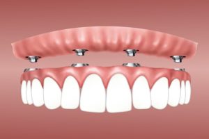 Tout ce que vous devez savoir sur le prix implant dentaire mâchoire complète Espagne
