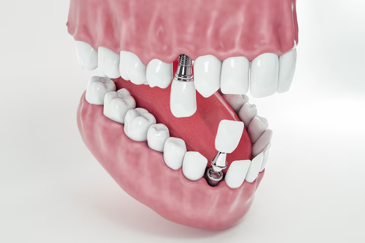 Comment le prix implant dentaire reflète-t-il la qualité et la durabilité du soin ?
