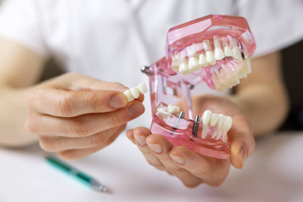 Comment l'implant dentaire Espagne peut-il transformer votre sourire tout en restant abordable ?